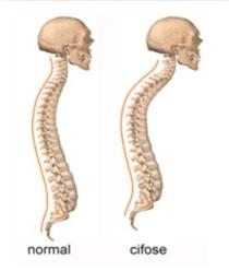 Cifose - coluna vertebral